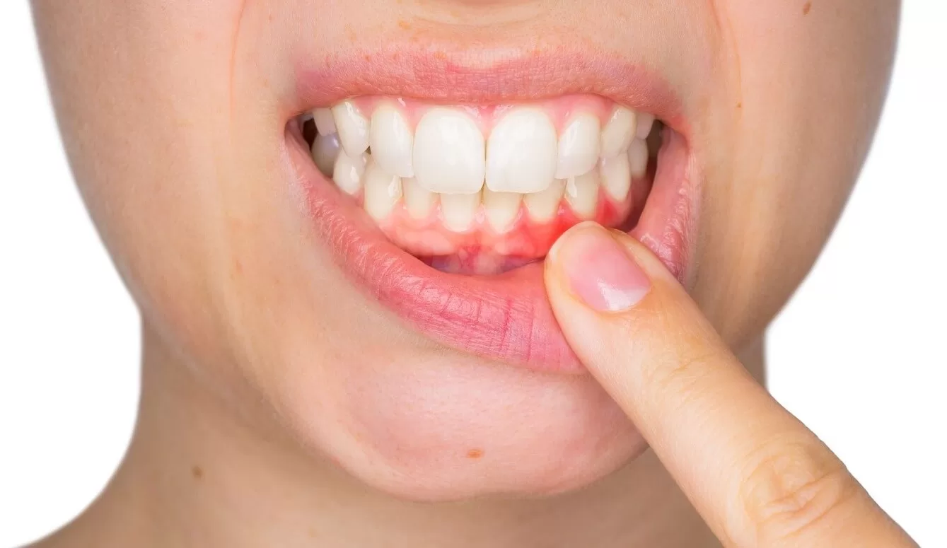 gum-desease